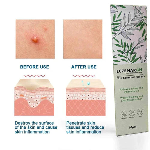 Ecze+ Anti Fungal Spray (Buy 1 Get 1 Free🔥🔥)