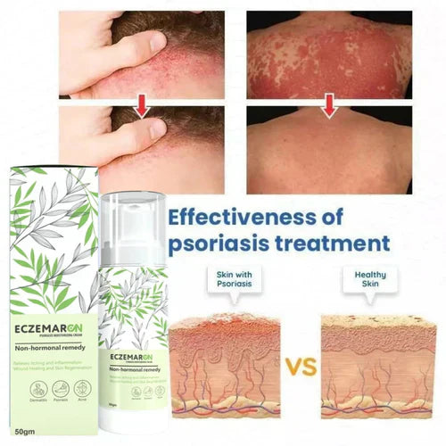 Ecze+ Anti Fungal Spray (Buy 1 Get 1 Free🔥🔥)