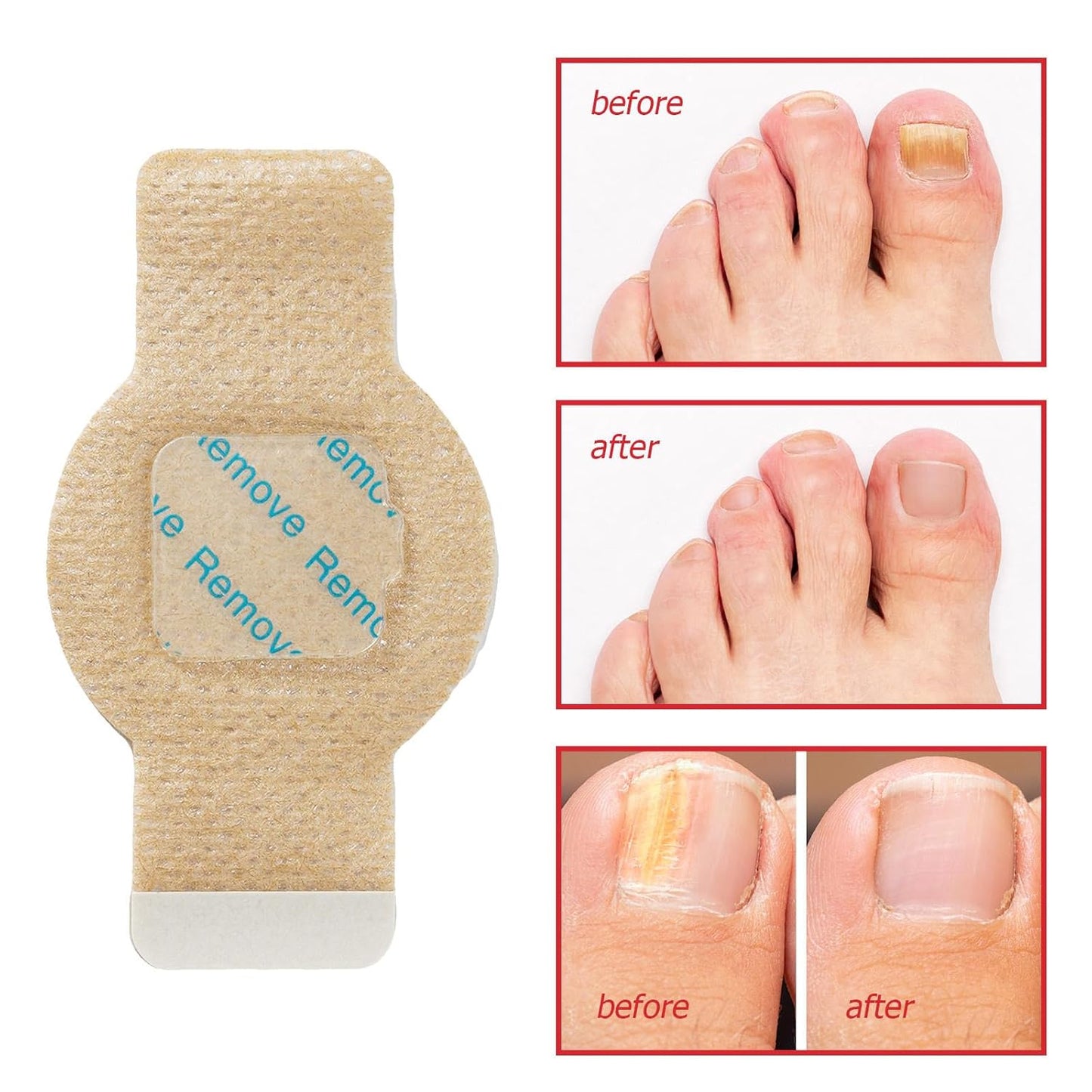 NailHeal™ - Fungal Nail Patches 🌿💅 ( Buy 1 Get 1 Free🔥🔥)